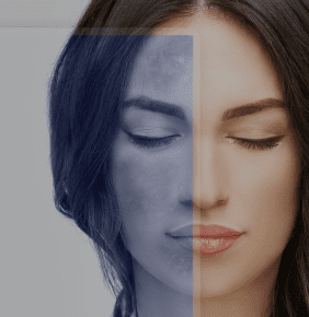 Advanced RF Laser Treatment