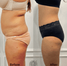 Hip augmation before & after