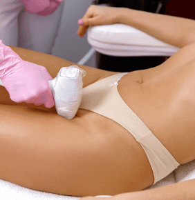 Laser hair removal
